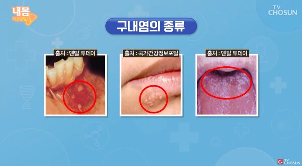 [톡톡 100세 인생] 입 속의 시한폭탄...구내염 예방하려면?